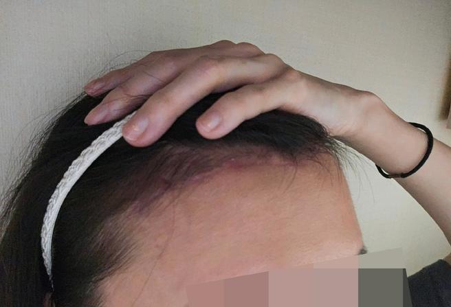 額頭縮小