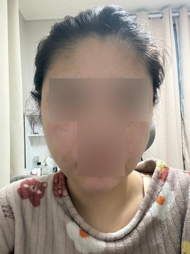 얼굴 지방흡입