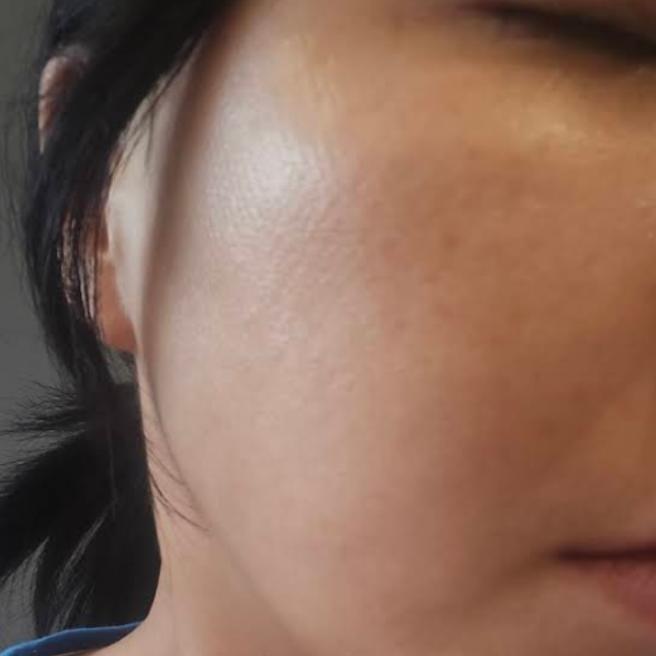 포텐자 맞고 5일됐어요!  생각보다 빨리 가라앉아서 놀랐어요