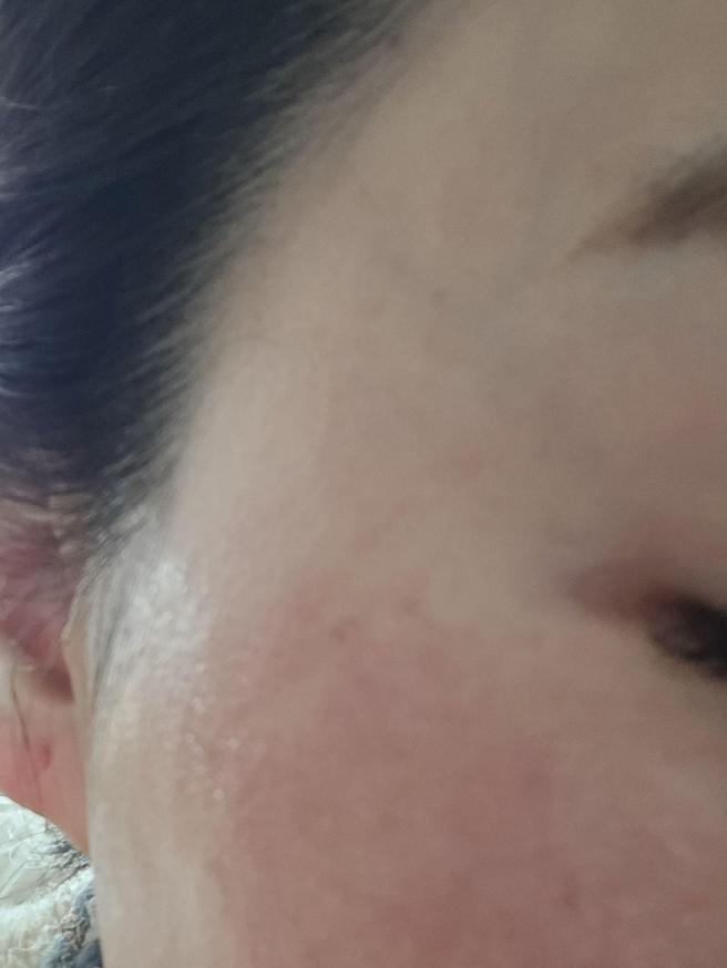 수면으로 통증 없이 받은 포텐자, 일주일 뒤 결과가 기대돼요~!