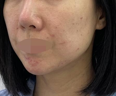 수면으로 스킨보톡스+인모드 한번에 챙기려고 방문했어요
