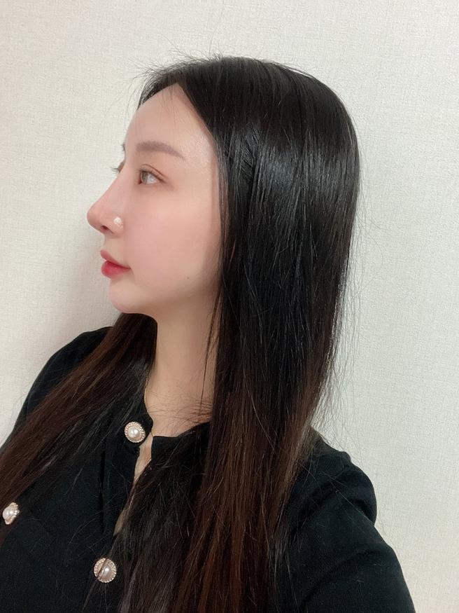 안심 코 재수술