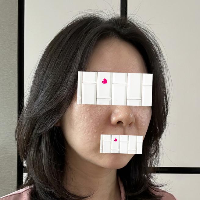 리쥬란 1일차 피부 바뀔 생각에 설레요 ㅎ