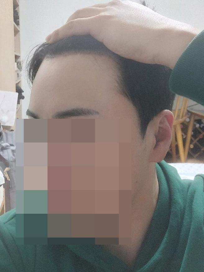 額頭縮小