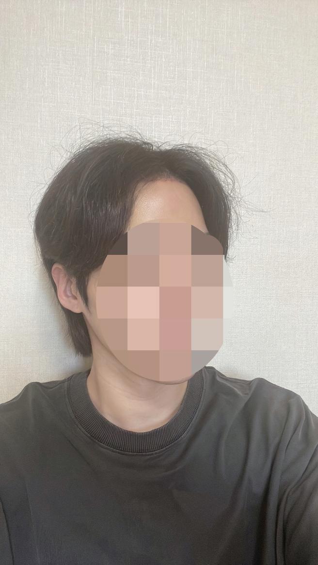 額頭縮小