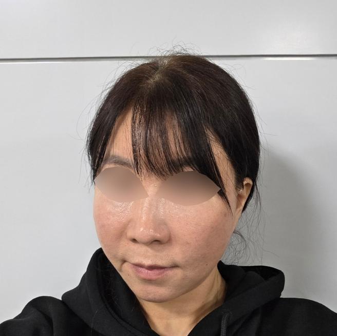 리쥬란 5일차, 눈밑이랑 볼 푸석함 달라지는 중