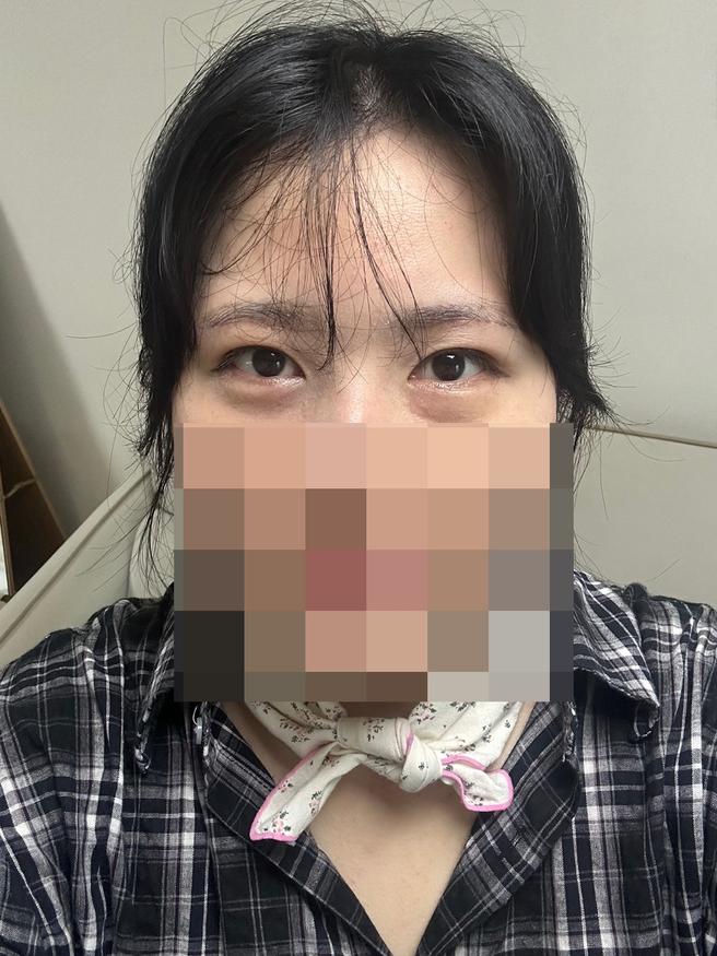 눈썹거상술