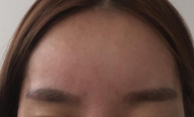 Toning Pigment Removal Program - Pigment Concentration Improvement Program (5 sessions)