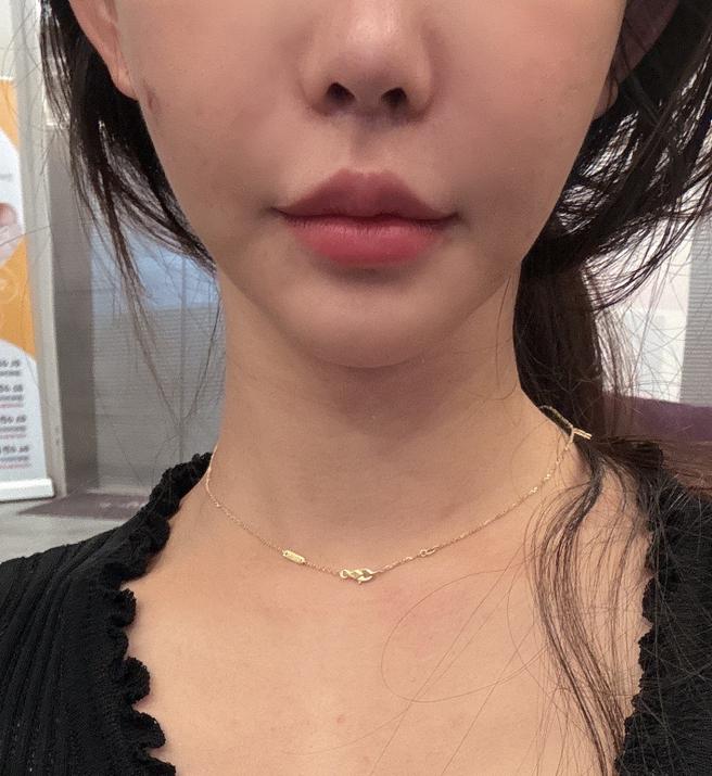 꾸준히 관리하는 편인데 슈링크 받길 잘한 것 같아요!! 만족스러워요~
