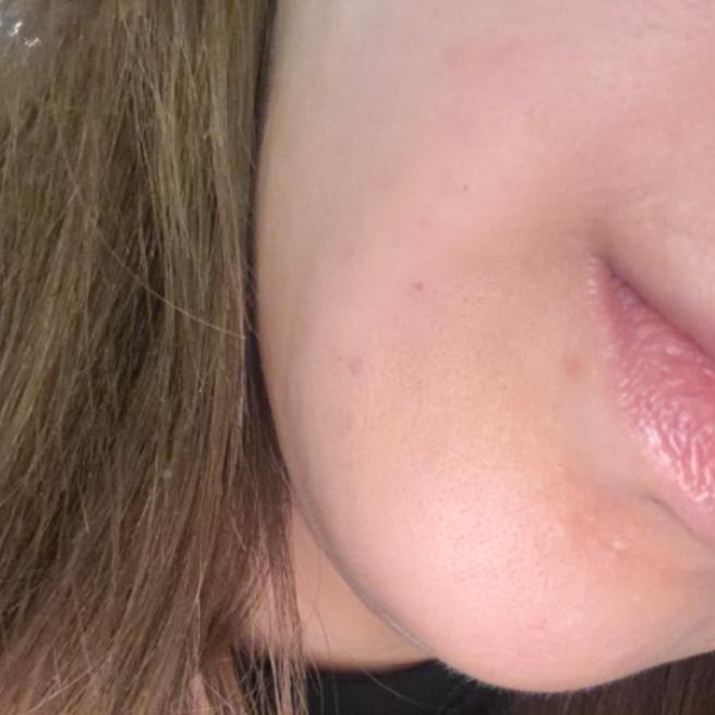 써마지 리프팅 후기, 빠른 일상 복귀가 가장 좋았어요