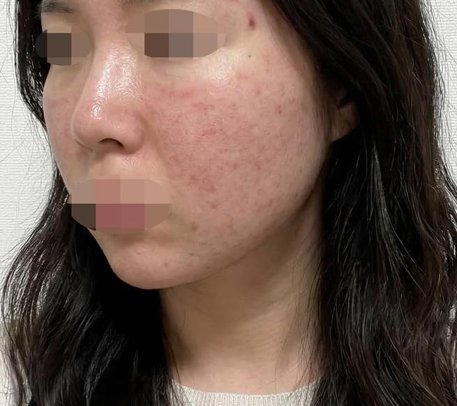 효과 좋아서 재방문했는데 상담부터 시술까지 꼼꼼한 것 같아요 ㅎㅎ
