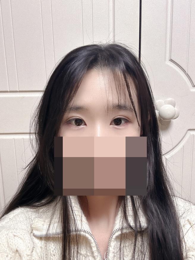 自然粘连双眼皮