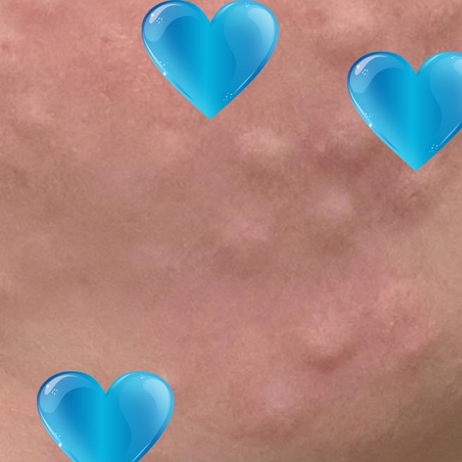리쥬란 3일됐어요 ^^ 피부가 한결 편안해진 느낌이에요!
