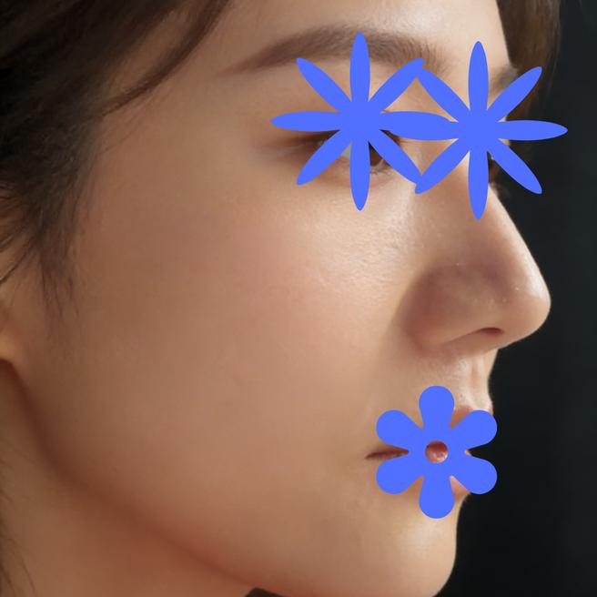 리팟레이저 + PDRN 연어주사 2cc + LDM 5mm 기준