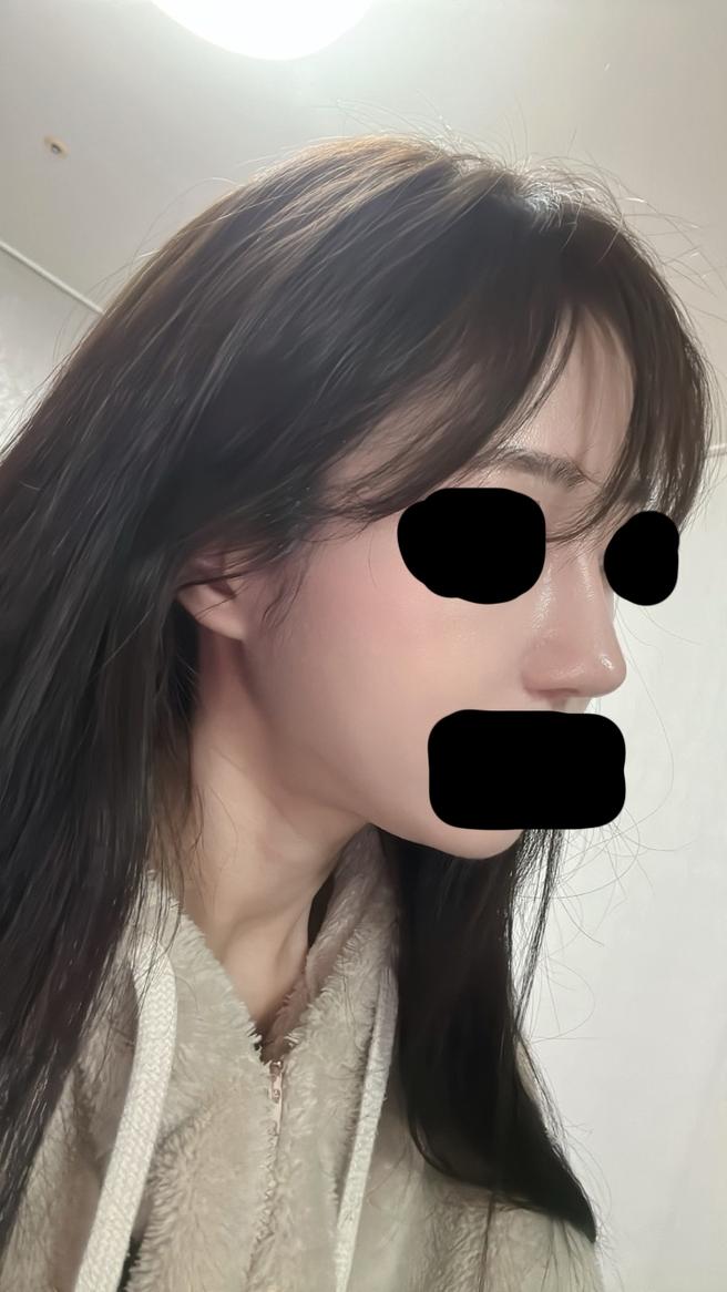 자가늑연골코재수술