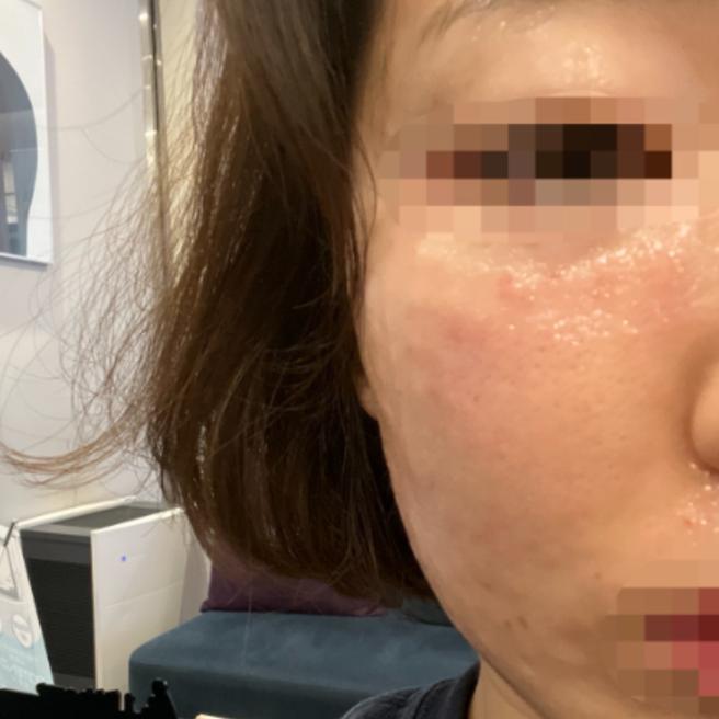 리쥬란 1일차, 엠보가 촘촘하게 올라왔어요