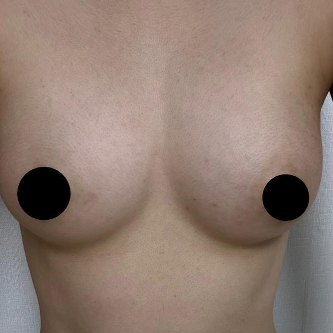 PRP Breast Fat Grafting