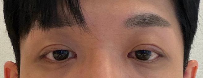 男性眼睛矫正