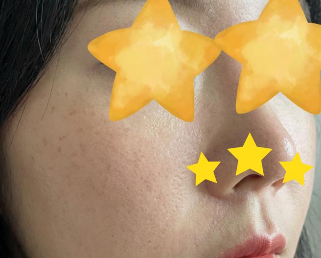 한달전에 리쥬란 맞았는데 슬슬 효과 느껴지는 것 같아요!