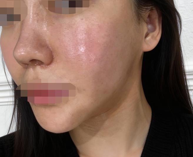 온다리프팅 좋다고 해서 왔는데 과한 권유 없이 편하게 받았어요 ㅎㅎ