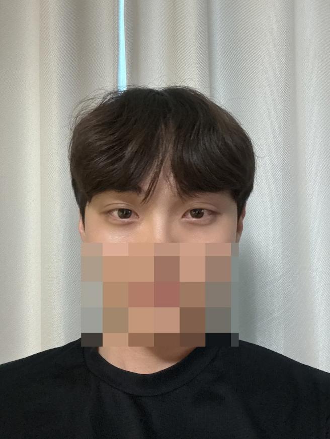 울통불퉁 했던 눈 밑이 펴지면서 애교살도 더 선명해진 느낌이라 맘에 들여요.