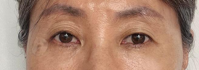 눈밑지방재배치