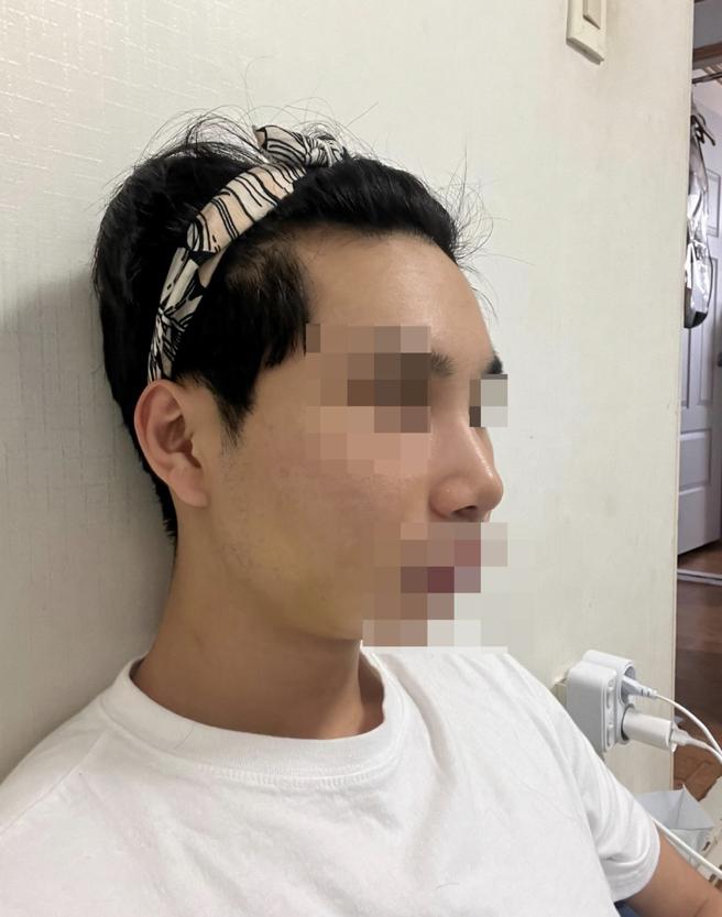 男性隆鼻术