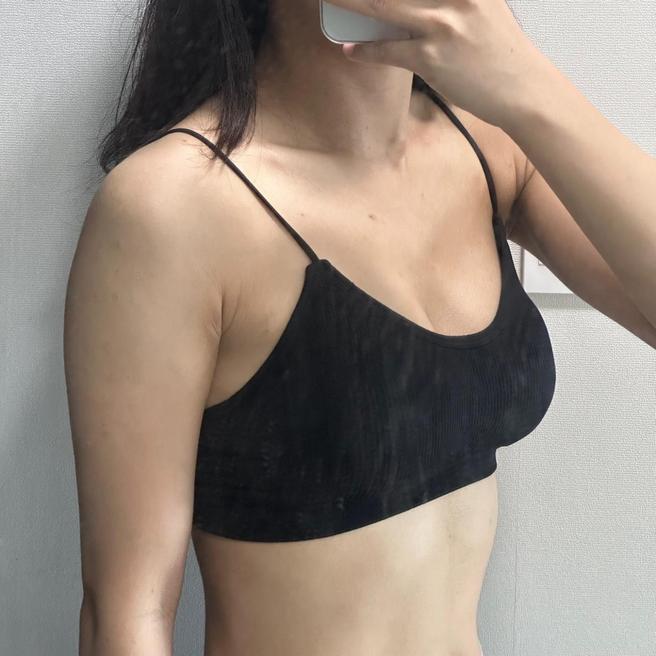 내추럴가슴보형물