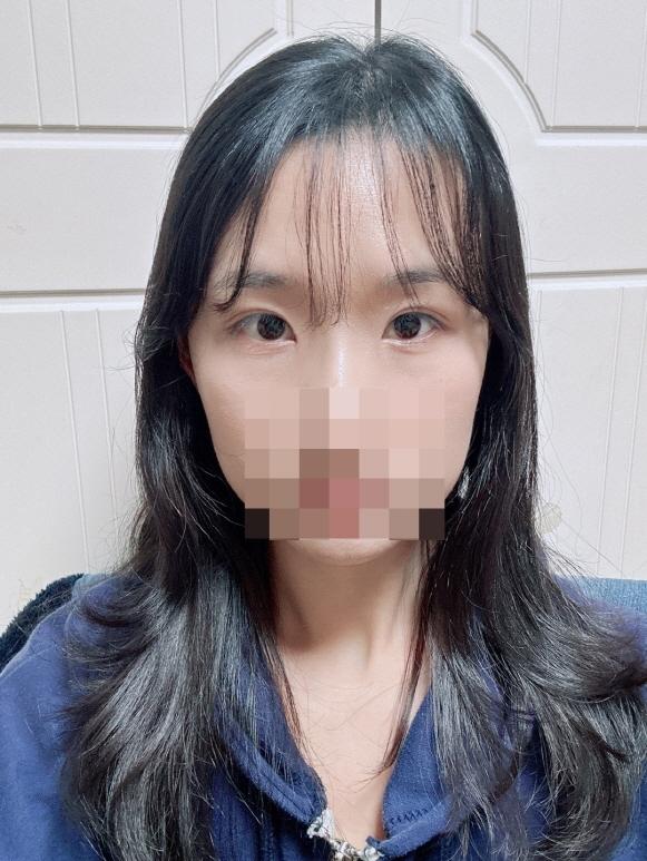 부분절개쌍꺼풀