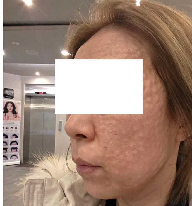 첫 방문인데 수면 마취 괜히 걱정했어요ㅎㅎ 촘촘하게 잘 해주셔서 만족~