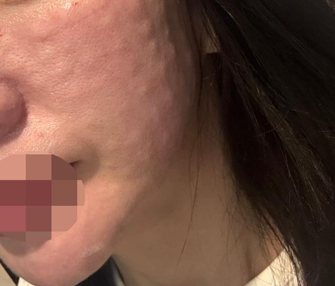엠보 빵빵하게 잘 잡혀서 리쥬란 재방문했어요!!