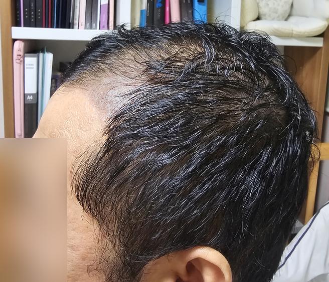 ソウルアイ毛髪移植