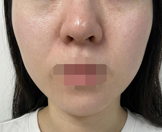 홍조이랑 모공 고민으로 엑소좀 받아봤습니당~