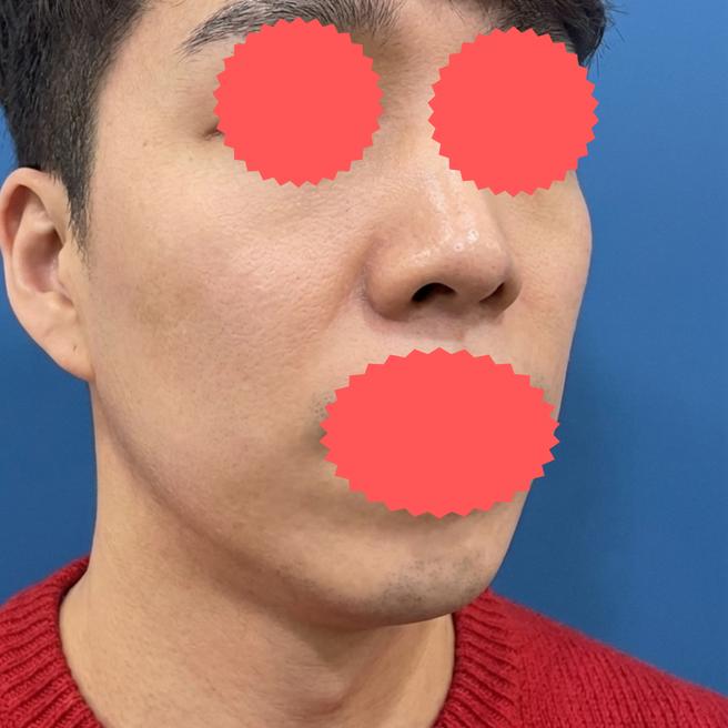 남자도 편하게 받고 왔습니다, 쥬베룩 1주차 경과