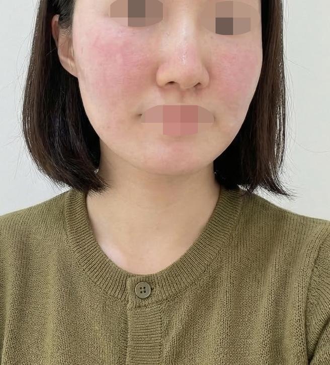 피부 관리 다시 시작하려고 리쥬란 받았어요~ 강남역에서 가까워서 너무 좋아요!