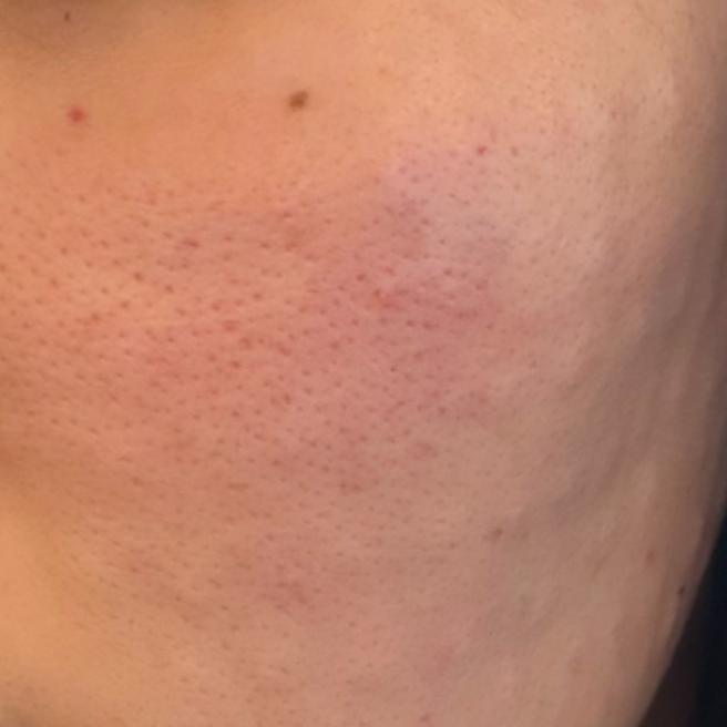 리쥬란 3일차, 건조하고 푸석한 피부 때문에 받았어요 