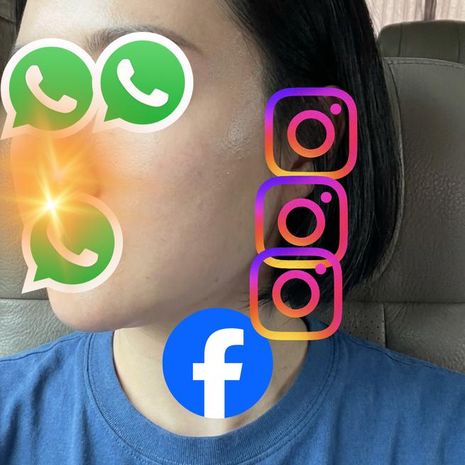 어제 리쥬란 맞고 하루 지난 얼굴 상태 공유합니다