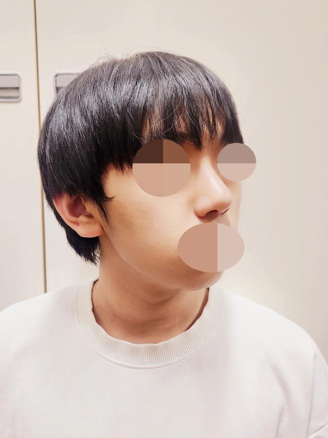 남자코성형
