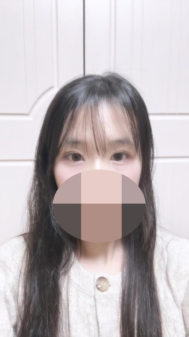 眼幅矯正＆眼瞼下垂
