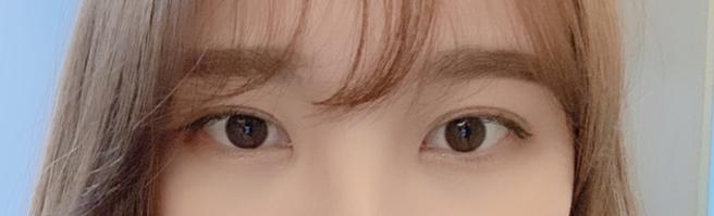 자연유착 쌍꺼풀