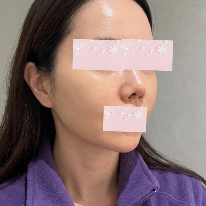 울쎄라 당일, 시술 끝나고 나왔는데 결과가 너무 궁금해요