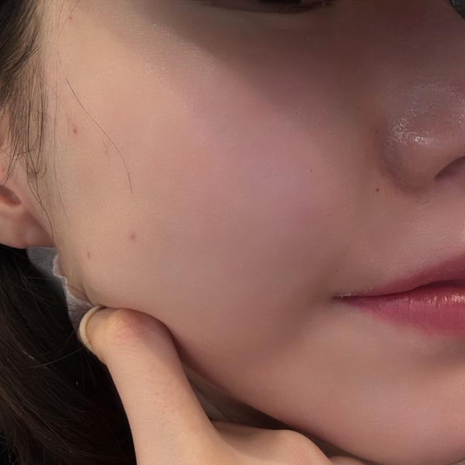 시술 끝나고 거울 봤는데 피부가 촉촉하고 맑아진 것 같아요