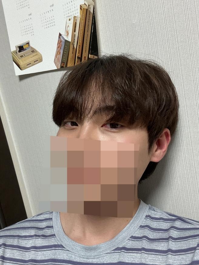 울퉁불퉁 했던 눈 밑이 펴지고 애교살도 더 선명해 졌어요