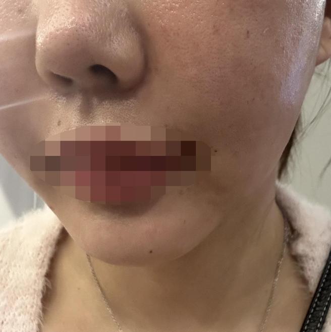 푸석한 피부 때문에 받았는데 편하게 잘 받은 것 같아요~