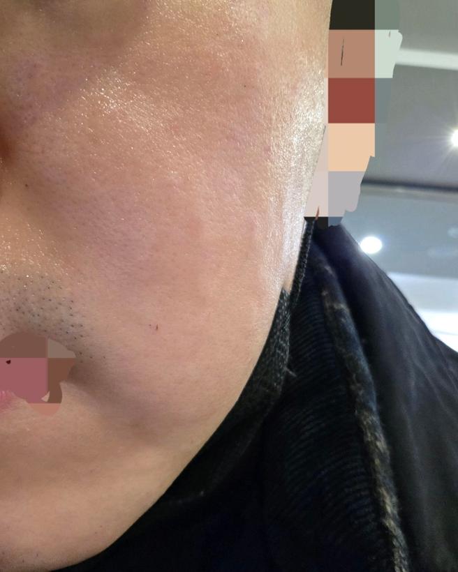 수면 리쥬란 4cc 맞았는데 진짜 안 아파요!