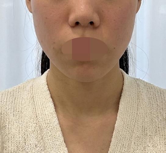 친구 소개로 방문, 병원 분위기부터 시술까지 다 만족이에요~
