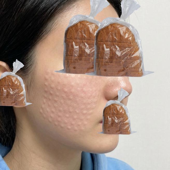 맞길 잘했다 싶었던 순간 | 리쥬란 2일차 후기