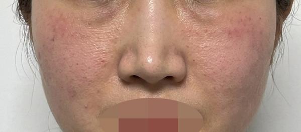 사진에도 보이는 화장 들뜸, 이제 끝내려고 리쥬란 시작했어요!1