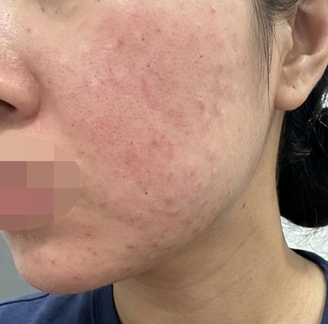 수면 덕분에 통증 없이 받은 리쥬란 + 슈링크, 진짜 추천이에요~