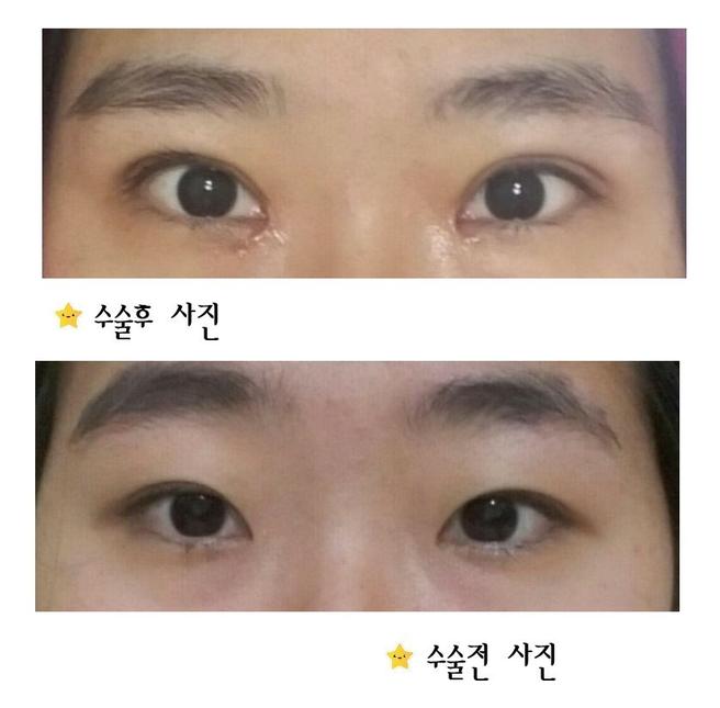 절개쌍꺼풀
